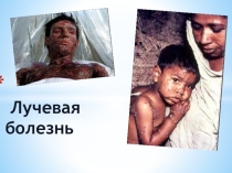 Презентация по ОБЖ ЛУЧЕВАЯ БОЛЕЗНЬ