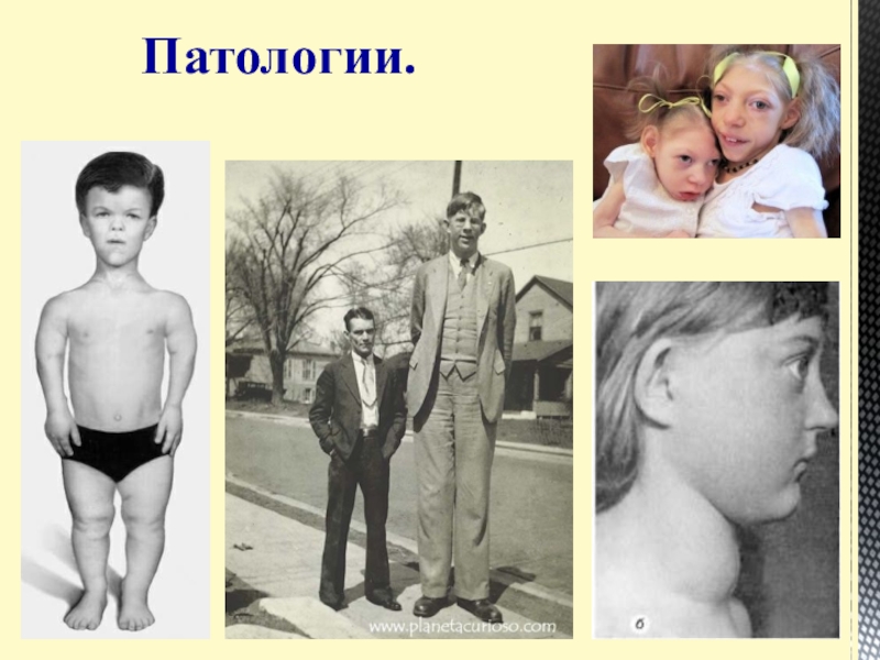 Презентация Статистические данные по заболеваемости йододефицитом населения В Большеглушицком районе Самарской области Патологии. Патологии.