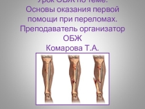 Презентация по ОБЖ Виды переломов, ПМП