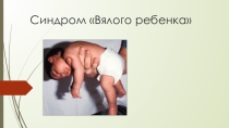 Синдром вялого ребенка
