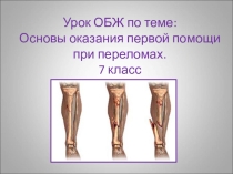 Презентация к уроку ОБЖ Оказание первой помощи при переломах.