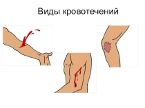 Презентация к уроку по ОБЖ на тему Первая медицинская помощь при ранениях