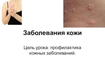Презентация по биологии для 8 класса на тему Заболевания кожи