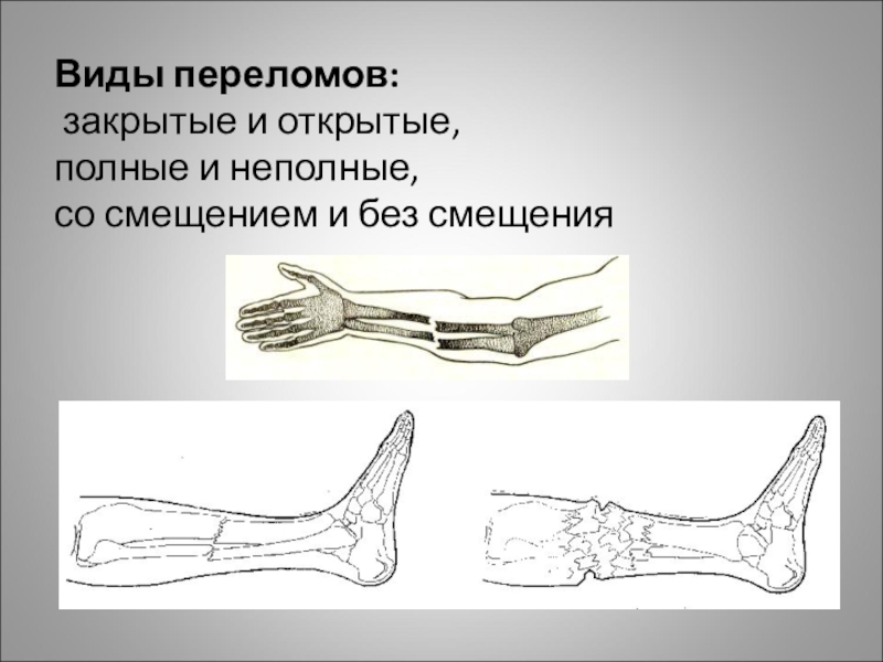 1 тип перелома. Открытые и закрытые передома. Переломы костей открытые и закрытые.