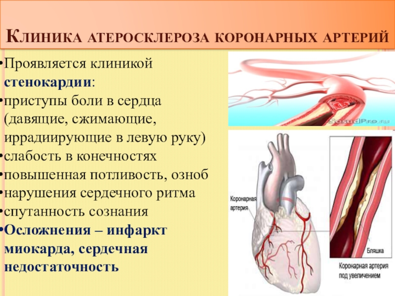 Коронарный атеросклероз