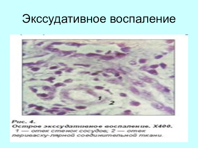 Экссудация это в патологии. Экссудативное воспаление. Серозное экссудативное воспаление. Экссудативное воспаление схема. Клетки в экссудативном воспалении.