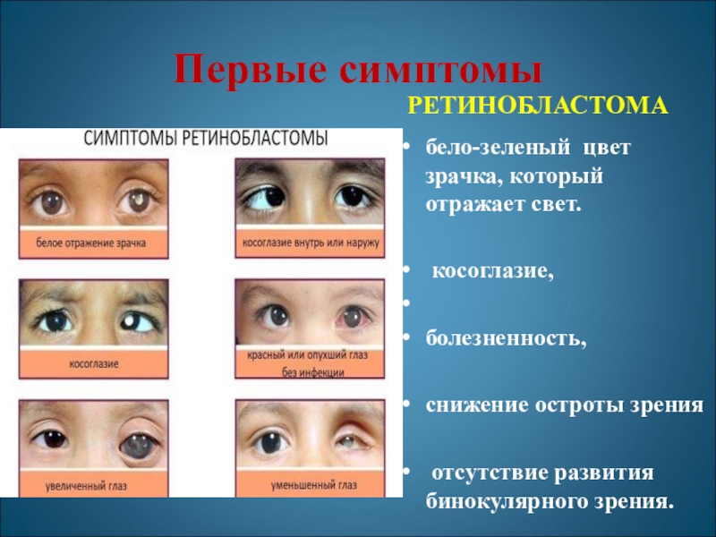 Зрение 1 симптомы. Ретинобластома 3 стадия. Ретинобластома 4 стадия. Симптомы ретинобластомы.