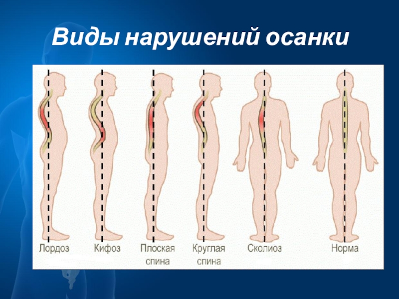 Нарушение осанки рисунок