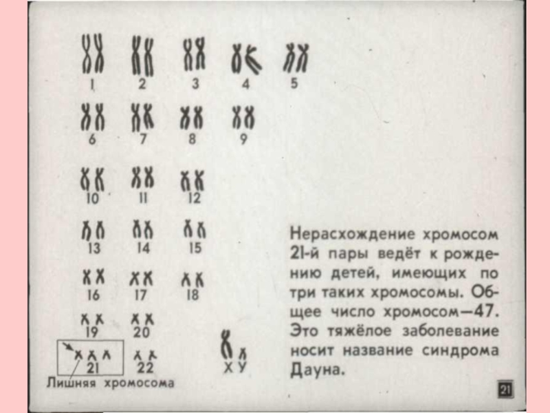 Лишняя хромосома. Лишняя хромосома в 21 паре. Лишняя хромосома в 23 паре.