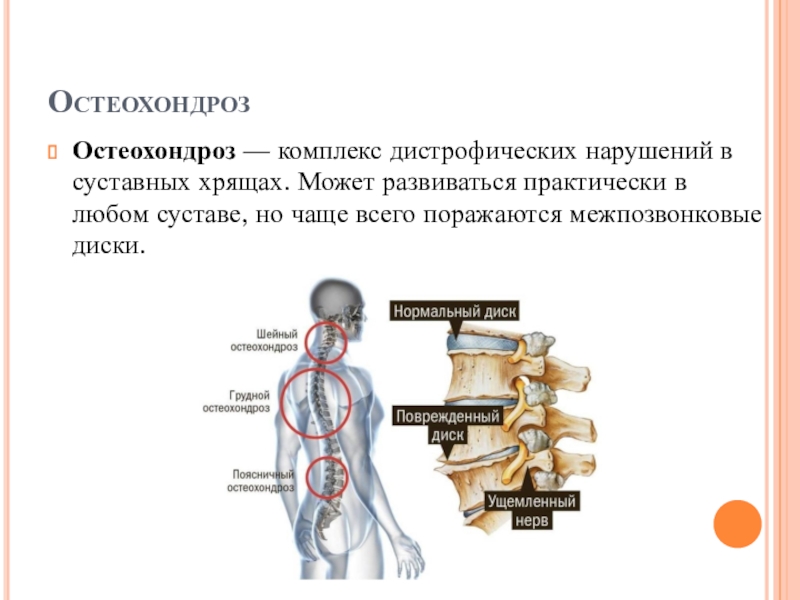 Реферат: Лечебная физкультура для профилактики и лечения остеохондроза