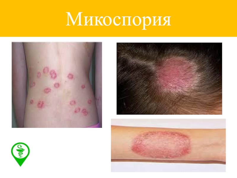 Презентация по фармакологии Антимикозные средства Микоспория Микоспория