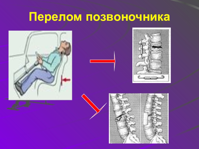 Перелом поясницы. Перелом позвоночника презентация. Застарелый перелом позвоночника. Перелом костей позвоночника.